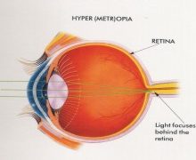 What is Refractive Error?